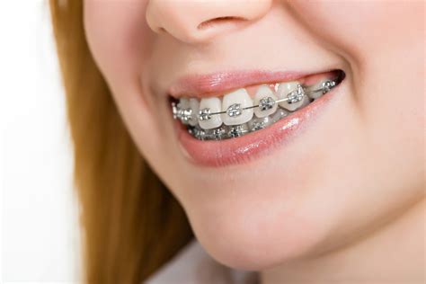 cuales son los brackets metalicos|colocación de brackets.